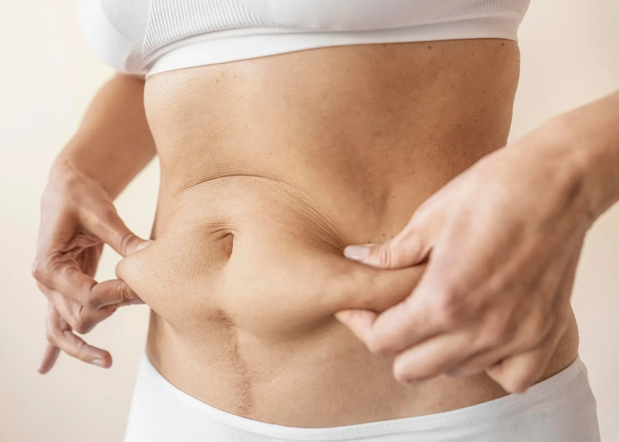 Cellulitebehandlung mit V-Shape: Wichtigste Vorteile