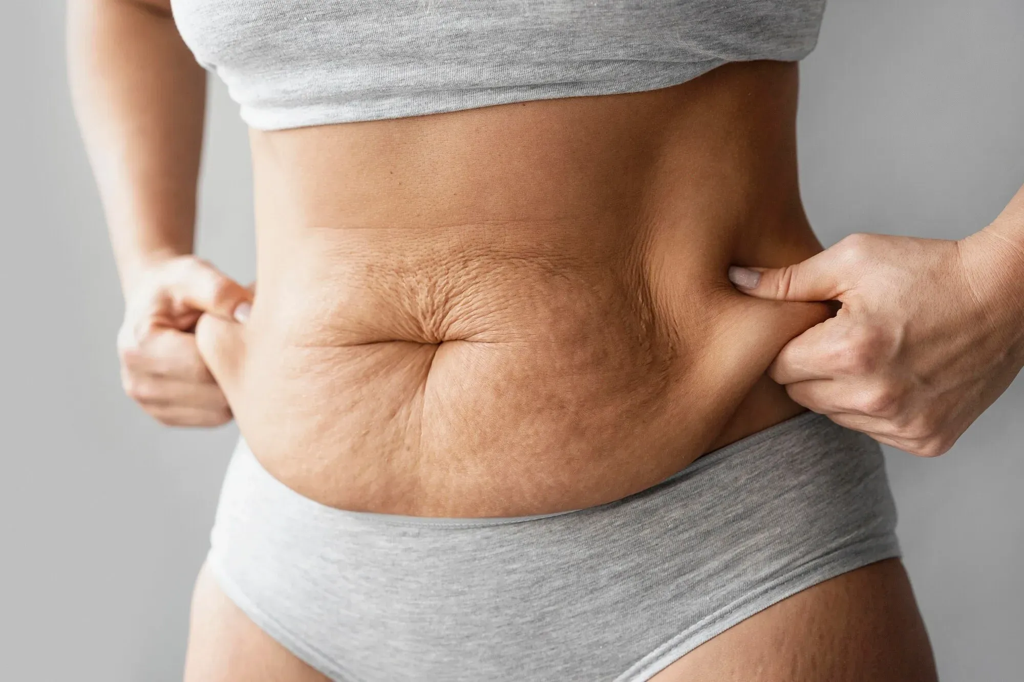 Cellulitebehandlung mit V-Shape: V-SHAPE Orangenhaut effektiv bekämpfen