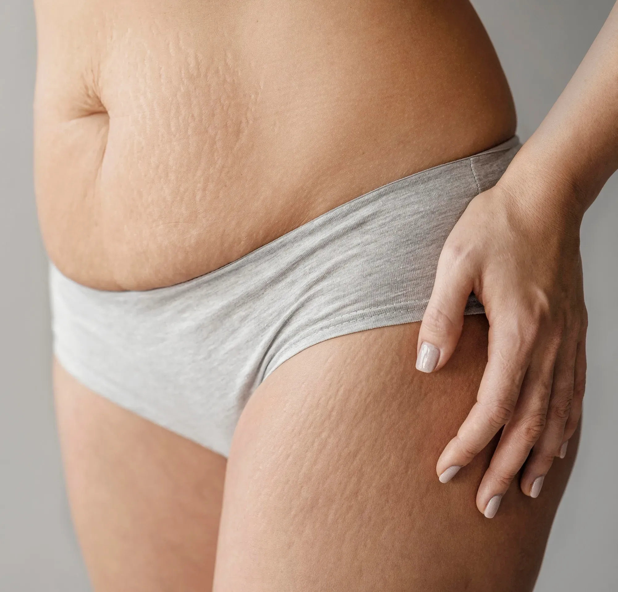 Dehnungsstreifen Behandeln: Dehnungsstreifen Behandlung mittels CO2-Laser & Fraktional RF Microneedling