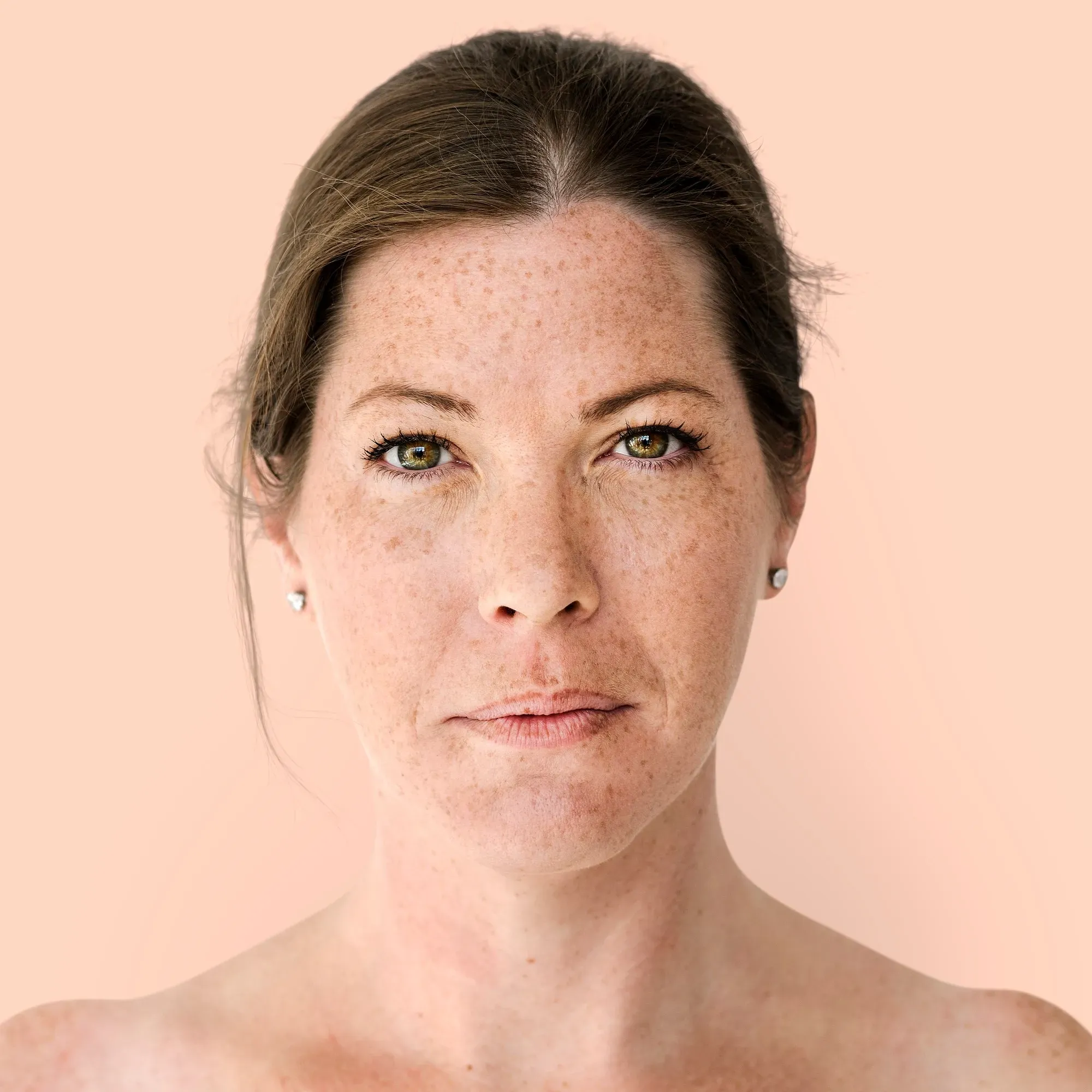 Melasma Behandlung: Vorteile