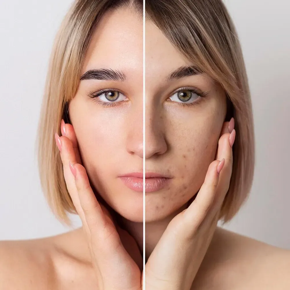 Skin Booster – Lifting: Mesolifting – innovatives Lifting für eine verjüngte und strahlende Haut-Skin Booster