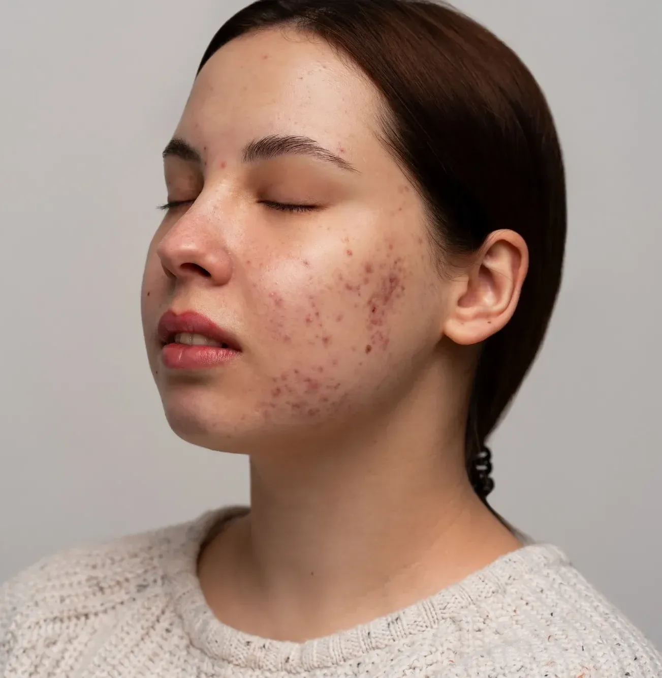 Couperose / Rosacea: Vorteile